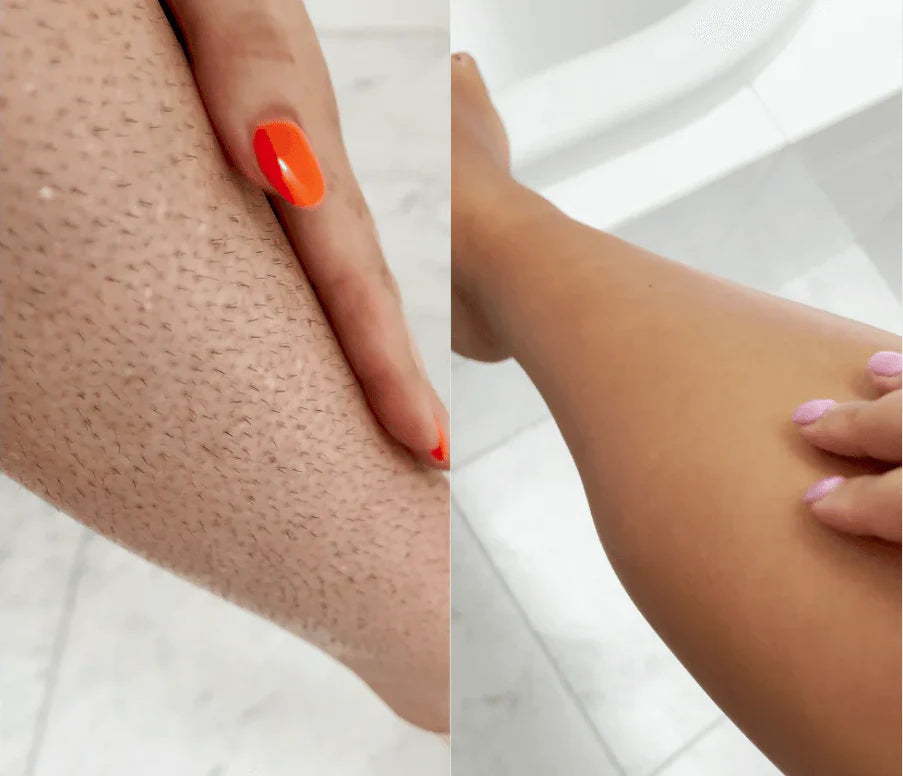 -30% Lumina IPL 9000 Laser Haarentferner